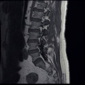 Get Your Herniate Disc Treated